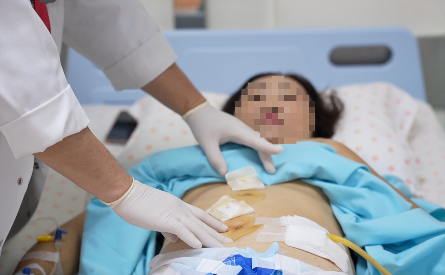 🔷NGHI LÀ TĂNG HUYẾT ÁP VÔ CĂN, HOÁ RA U TUYẾN THƯỢNG THẬN KHỔNG LỒ GÂY RA