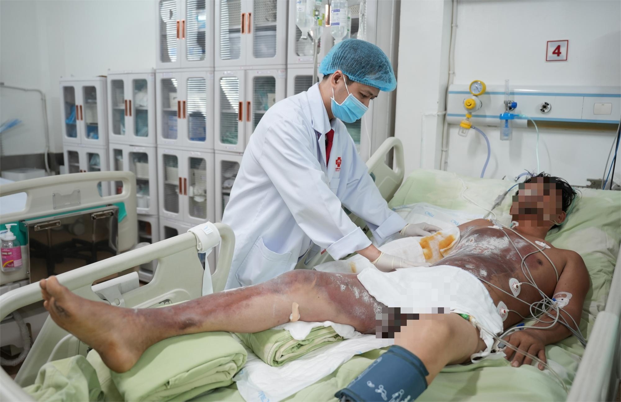 Trường hợp bỏng điện cao thế thương tâm