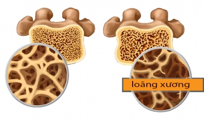 Xương bình thường và loãng xương