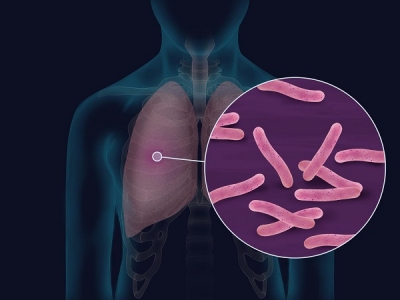 Bệnh lao do Mycobacterium tuberculosis gây ra