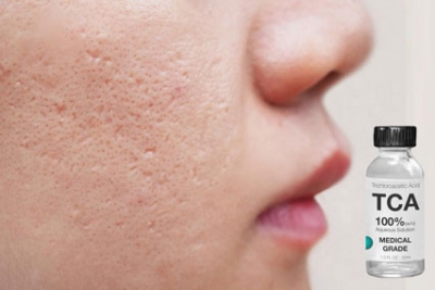 Nguyen ly hoat dong cua phuong phap tri seo cham TCA wed