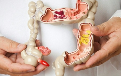 7 câu hỏi cần biết về polyp đại tràng