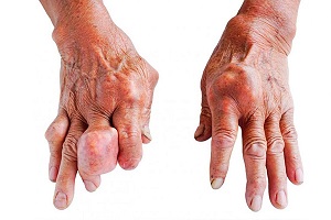Điều trị bệnh gout như thế nào? (How is gout treated?)
