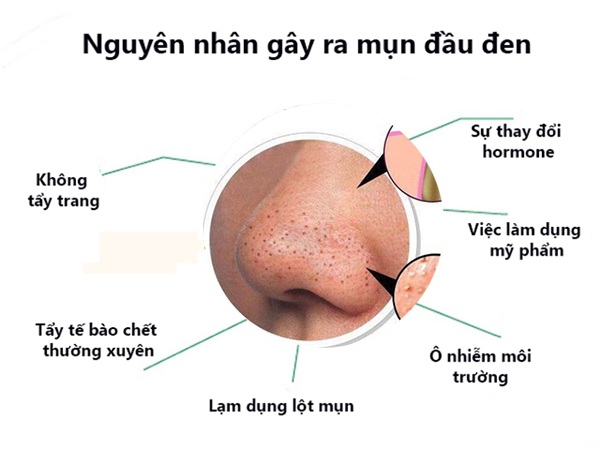 Hãy xem hình ảnh chúng tôi về cách nặn mụn đầu đen để bạn có được làn da sạch sẽ và tràn đầy sức sống nhất!