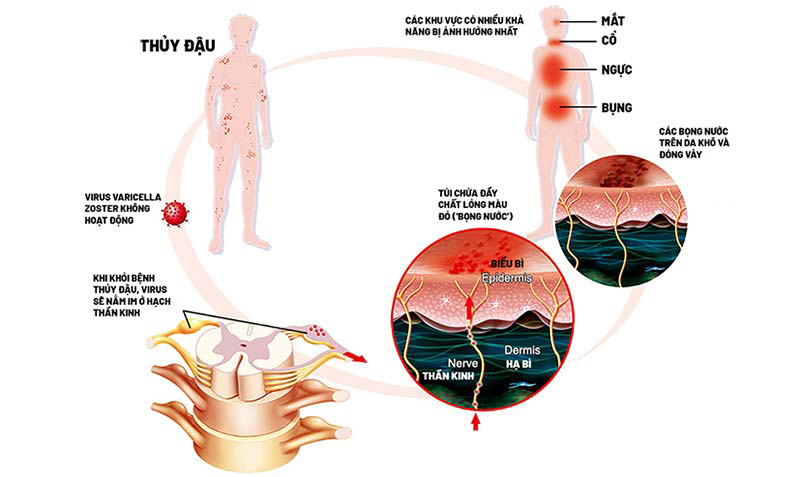 nguyen nhan gay benh zona than kinh
