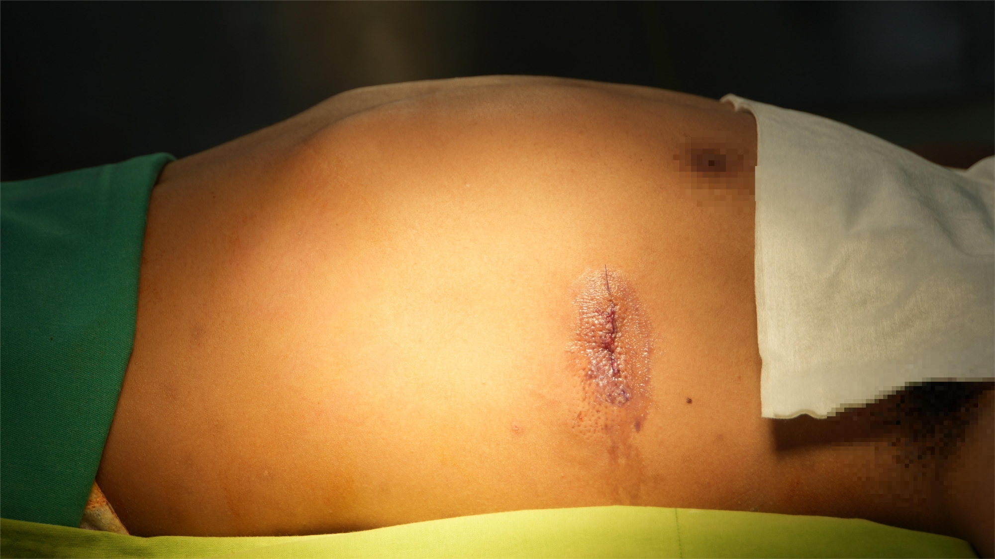 Ảnh: Bệnh nhân T.Y.T sau khi phẫu thuật